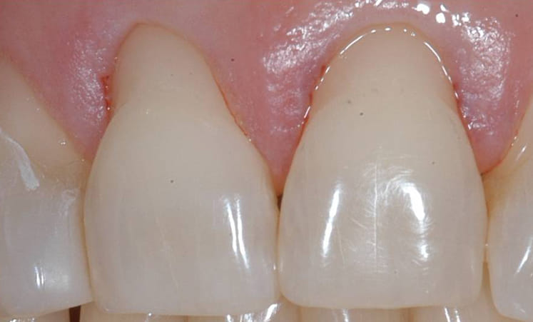 Gum Disease Progression Diagram