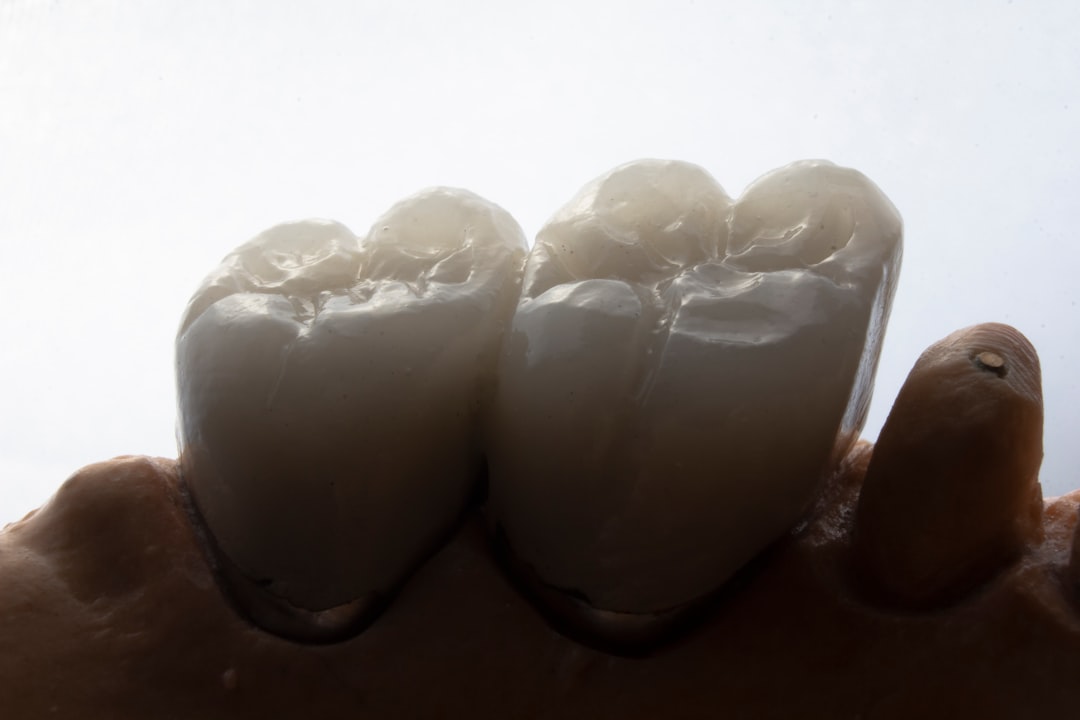 Dental bonding procedure