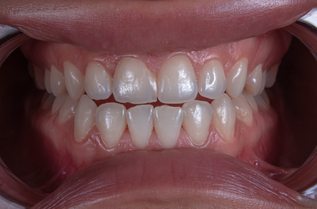 Smile makeover procedure