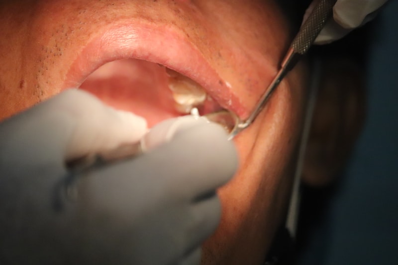 Tooth extraction procedure