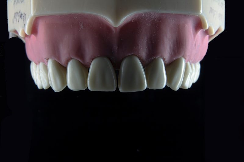 Dental veneers procedure